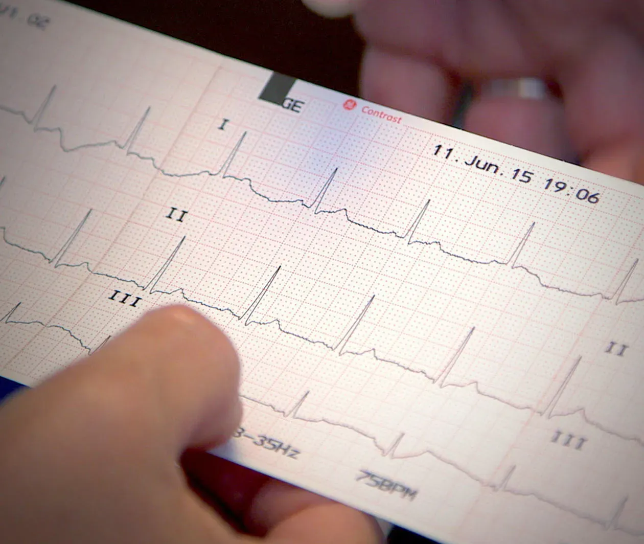 ECG Assessment: an Introduction for Healthcare Providers