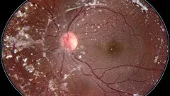 Retinal Atlas: Hereditary Chorioretinal Dystrophy